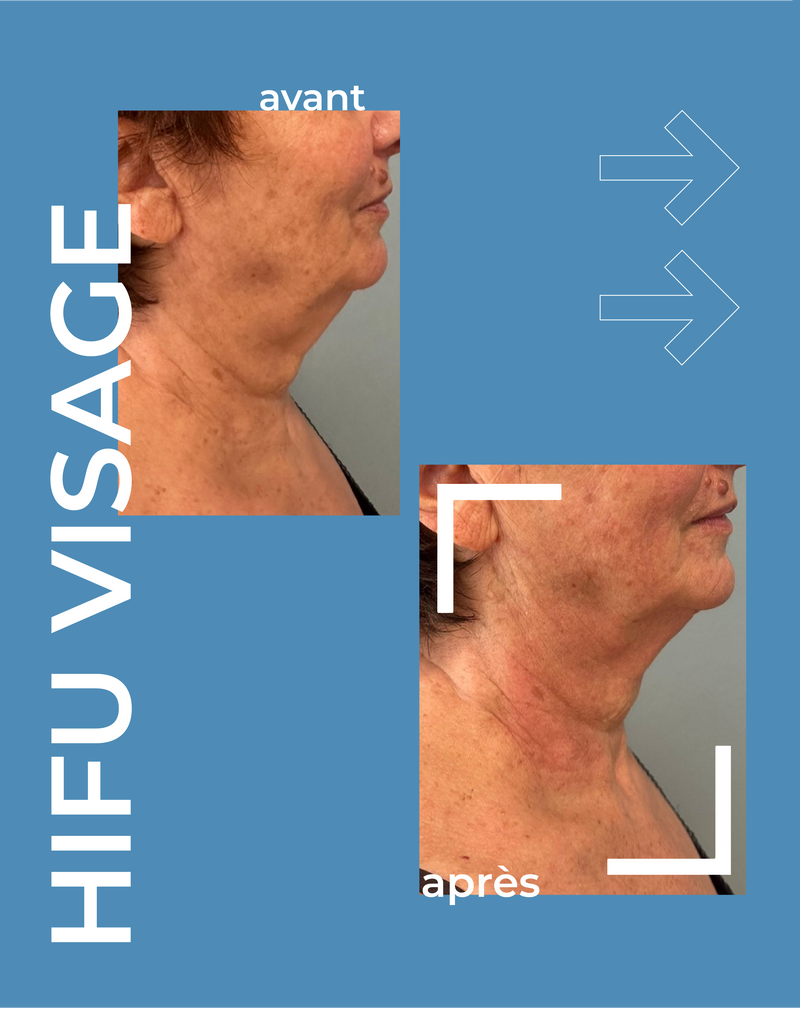 Résultats visibles sous combien de temps ?