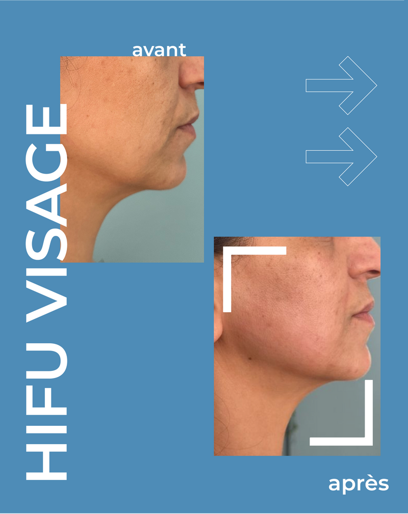 Résultats visibles sous combien de temps ?